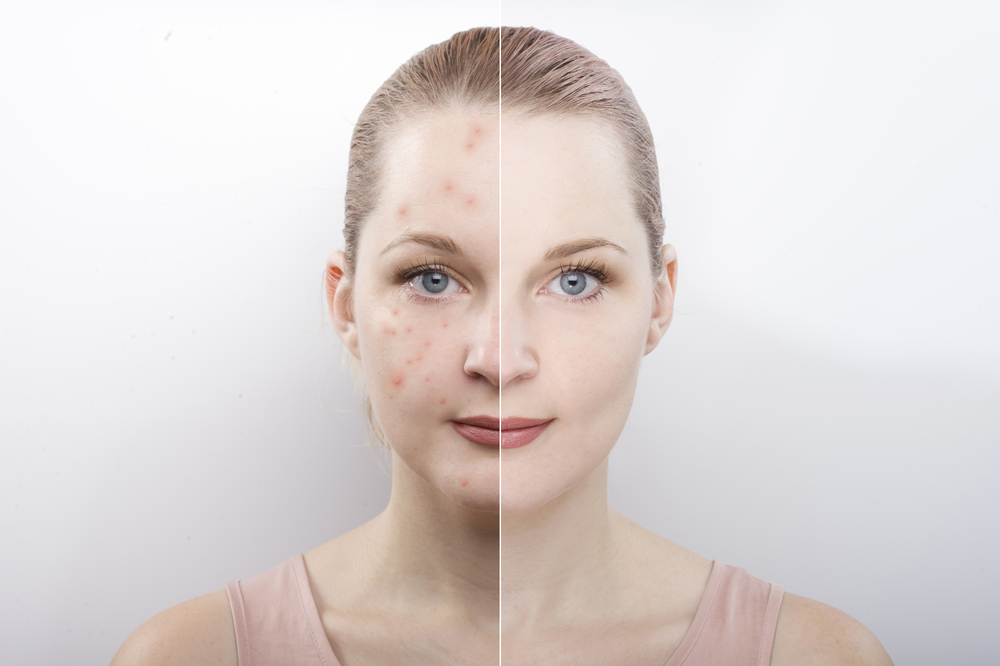 Come eliminare le macchie da acne con rimedi casalinghi