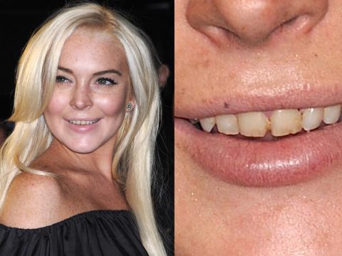 Lindsay Lohan, cos'è successo ai tuoi denti?