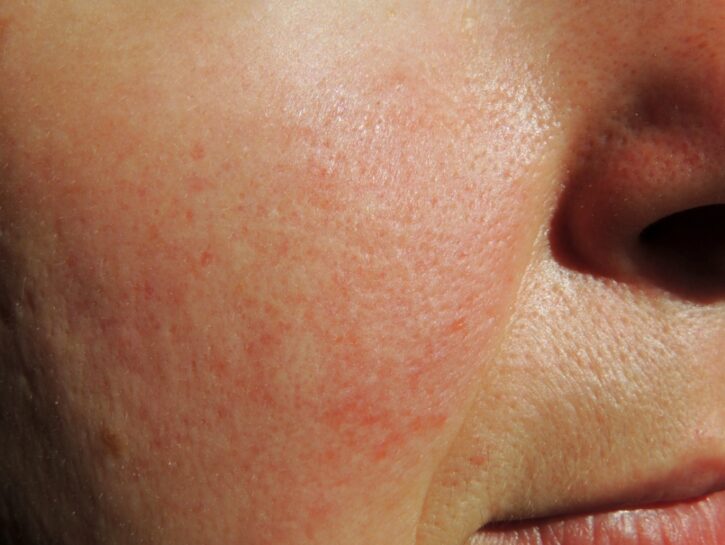 Couperose quali rimedi naturali? Donna Moderna