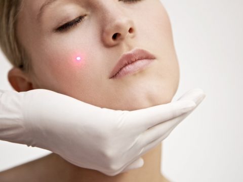 I laser che rassodano il viso
