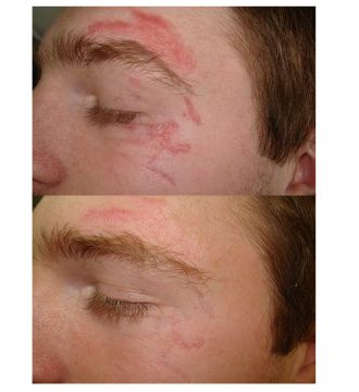 Cicatrici: nuovi interventi per eliminarle