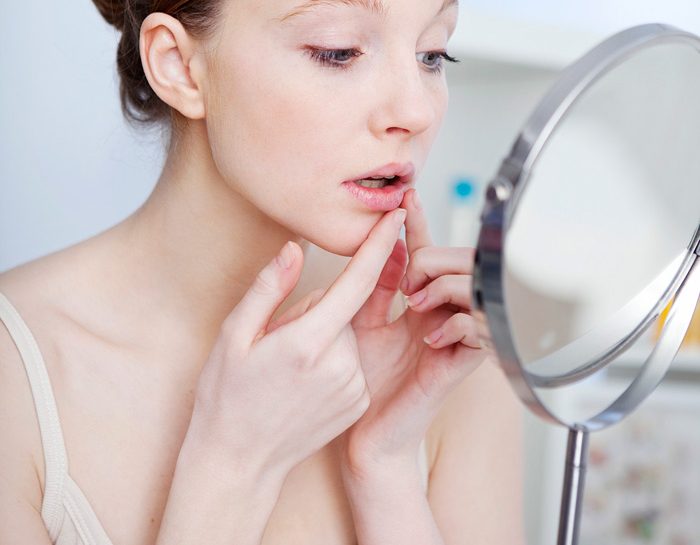 Herpes labiale: come sconfiggerlo e prevenirlo