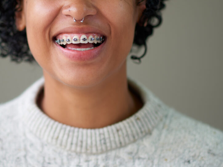 Come pulire l'apparecchio ortodontico