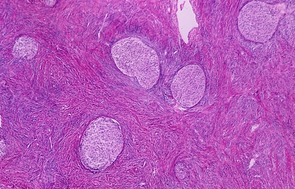 Brenner tumor neoplasm in the human ovary