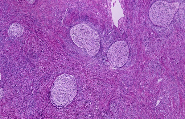 Brenner tumor neoplasm in the human ovary