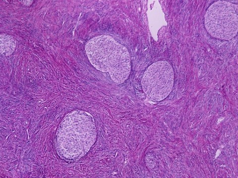 Perché dobbiamo conoscere il tumore alle ovaie