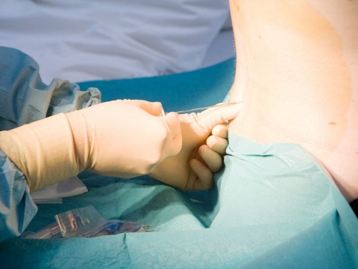 L'analgesia epidurale è una tecnica per ridurre il dolore del parto e consiste nel mettere, tramite