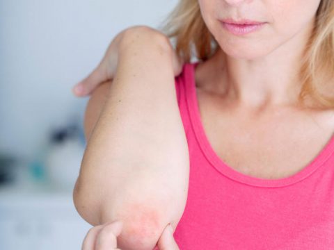 Psoriasi, una malattia invalidante della pelle