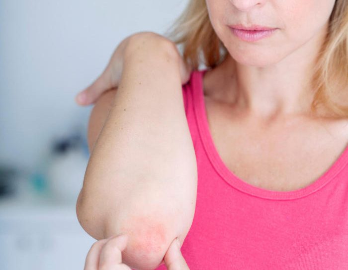Psoriasi, una malattia invalidante della pelle