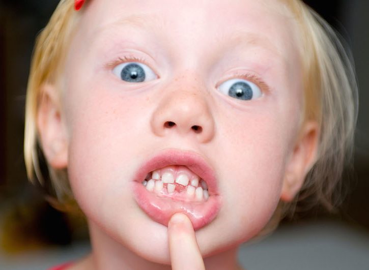 Caduta dei denti da latte: ecco perché è importante