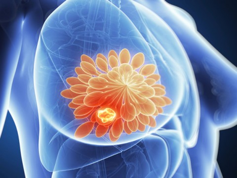 Il tumore al seno ora si cura senza togliere i linfonodi