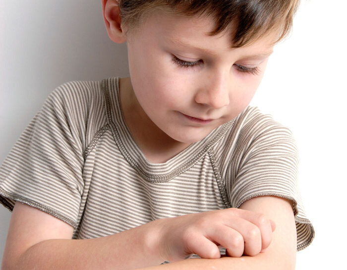 Dermatite atopica nei bambini: sintomi e cure