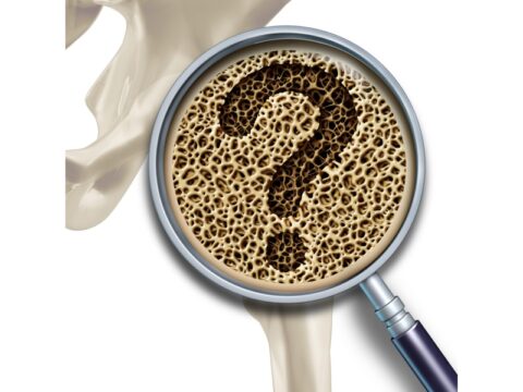 Prevenzione osteoporosi: ottimizza l'assorbimento di calcio
