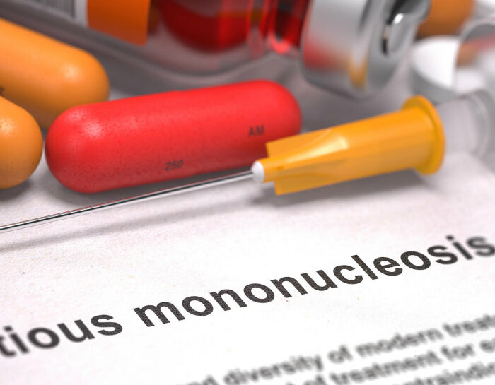 Mononuclesi: cura
