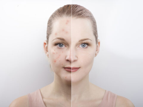 Come eliminare le cicatrici dell'acne