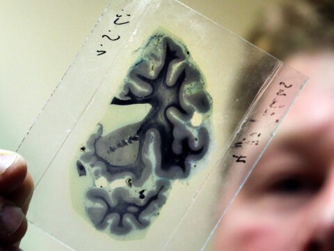 Alzheimer, scoperta la proteina che protegge la memoria