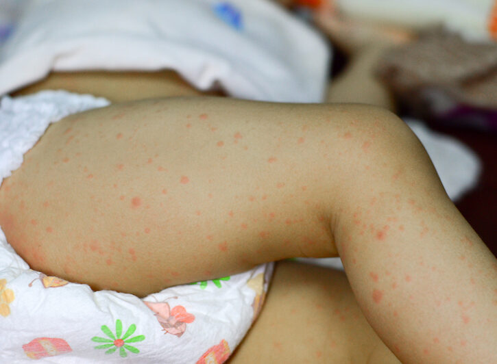 Morbillo: sintomi, vaccino e cura