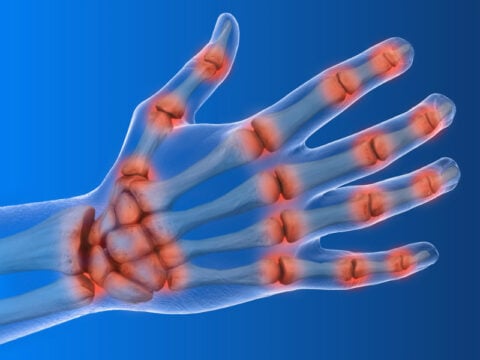 Artrite reumatoide: sintomi e cure