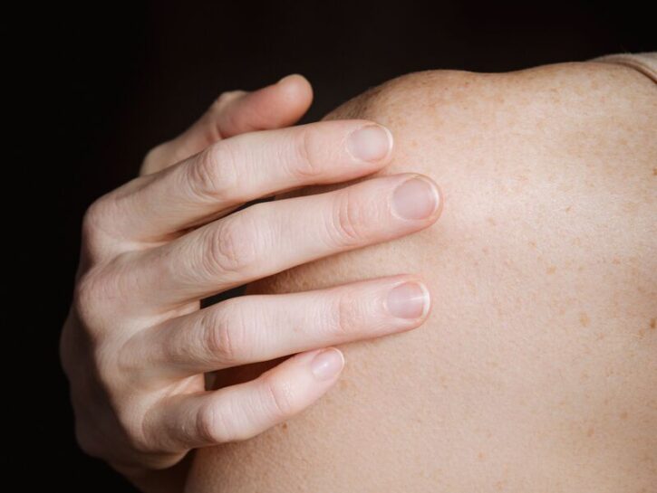 Porri della pelle, cosa fare? I rimedi naturali da provare