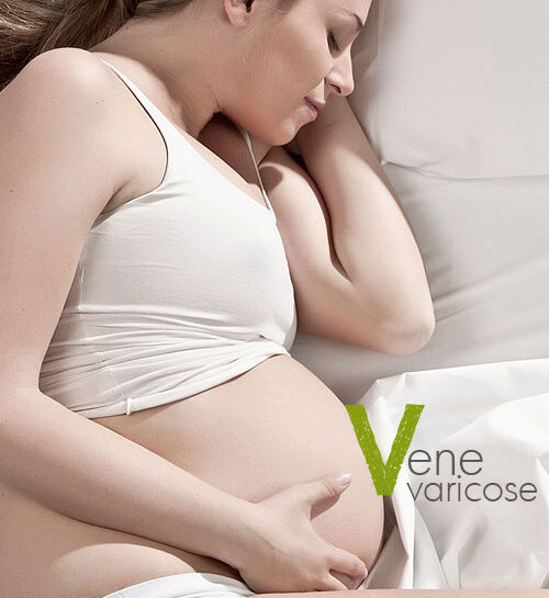 Vene varicose in gravidanza