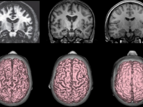 Alzheimer: la depressione possibile spia della malattia