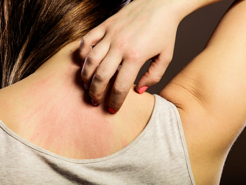 orticaria da stress