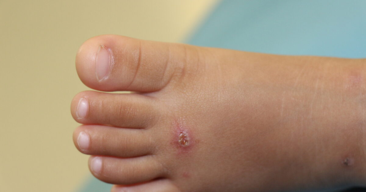 Impetigine: come si prende e come si cura questa patologia della pelle