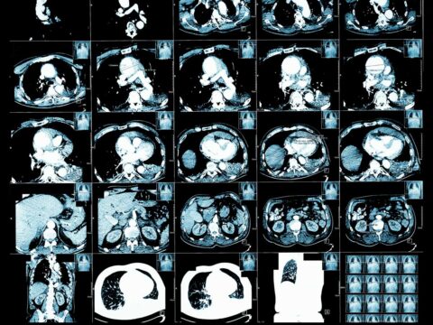 Cancro: in Italia il primato europeo delle guarigioni