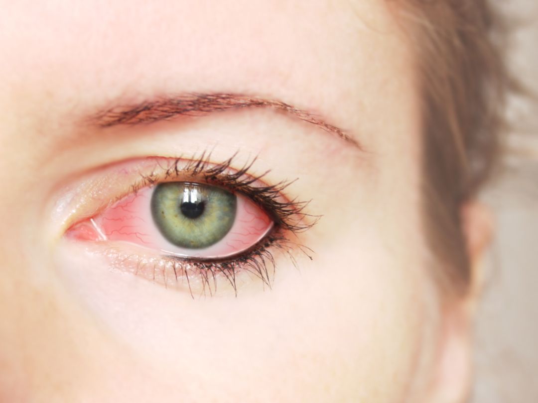 Occhio Rosso Cosa Puo Essere Donna Moderna