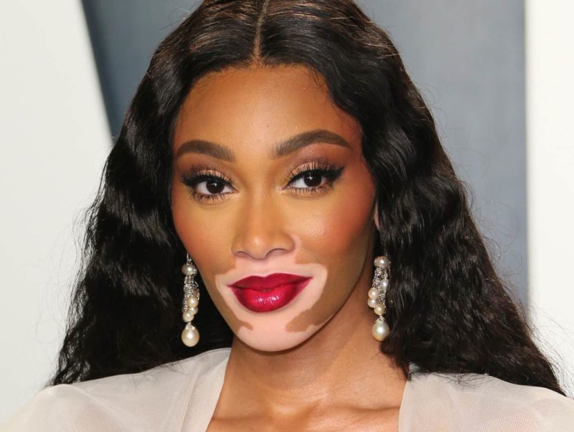 Winnie Harlow con la vitiligine