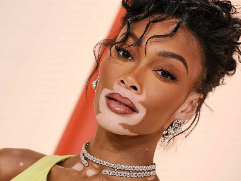 La modella Winnie Harlow