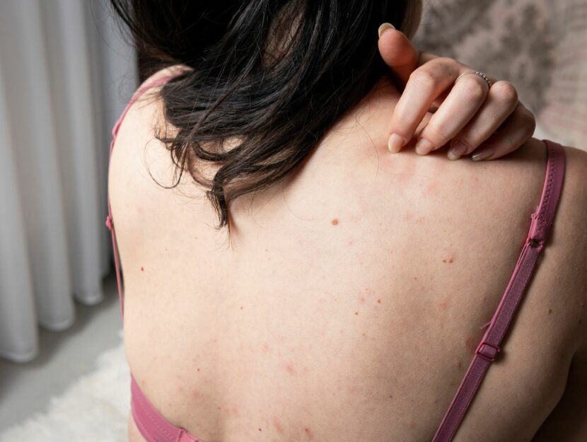 Donna con orticaria da mare sulla schiena