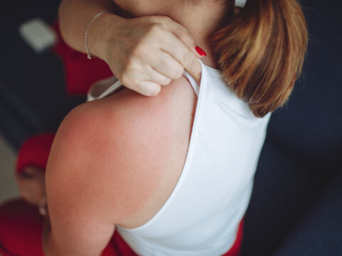 Come prevenire e come curare la dermatite solare