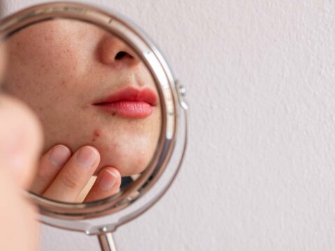 Make up per pelle acneica: il trucco per coprire i brufoli