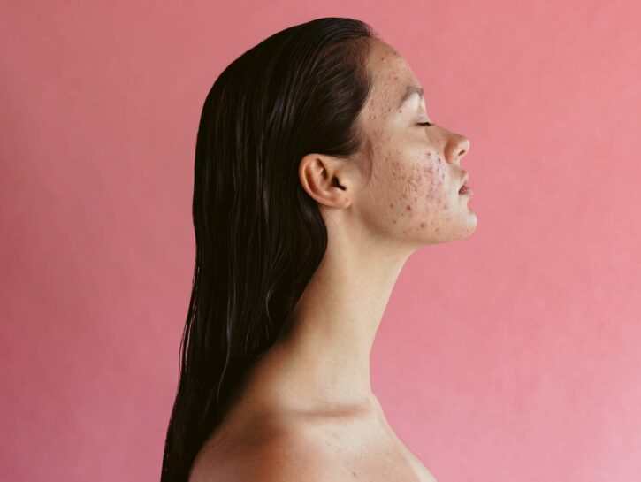 Acne, gli effetti della dieta secondo la scienza