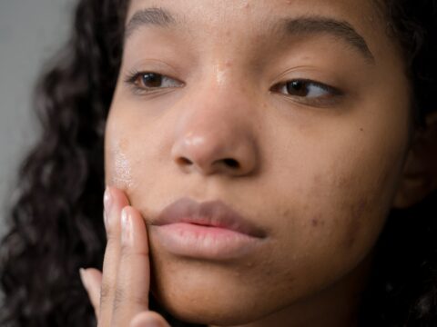 Come eliminare l'acne da mascherina