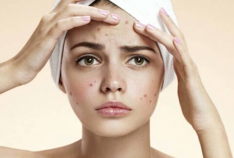 10 consigli per combattere l'acne