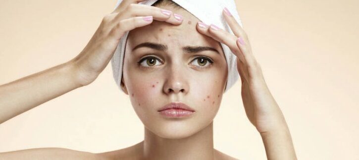 10 consigli per combattere l'acne