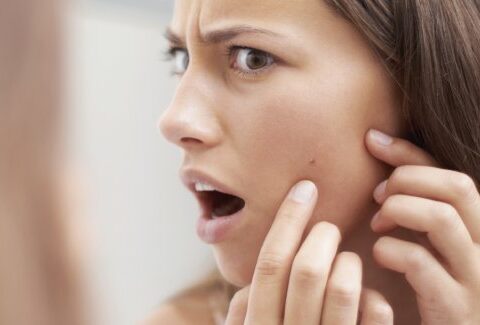 10 cose che peggiorano i segni dell'acne
