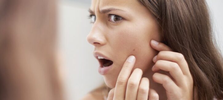 10 cose che peggiorano i segni dell'acne