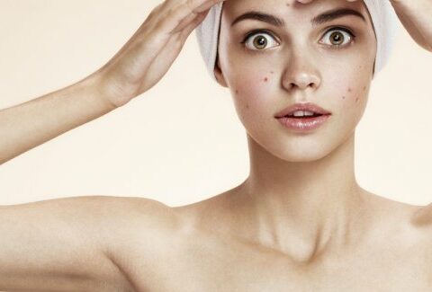 10 cose che solo se hai l'acne puoi capire