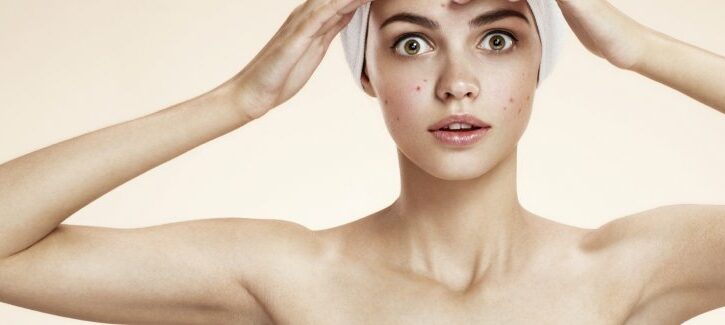 10 cose che solo se hai l'acne puoi capire