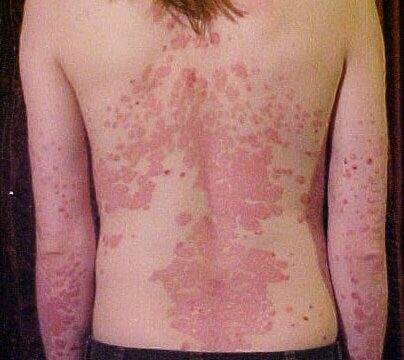Come si cura la psoriasi