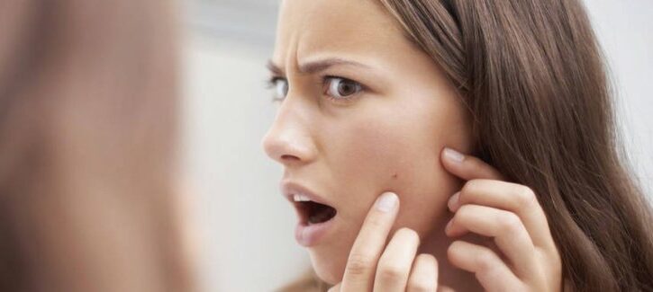 Acne: tutti i rimedi naturali