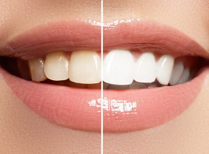 Alimenti da evitare dopo lo sbiancamento dei denti