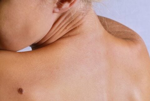 Come prevenire il melanoma cutaneo: i consigli dell'AIRC per la prevenzione dei tumori della pelle