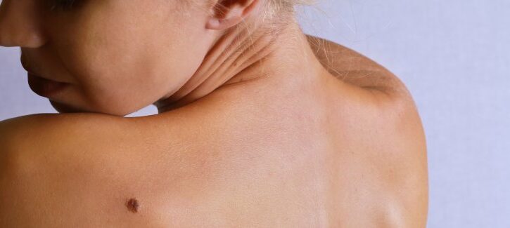 Come prevenire il melanoma cutaneo: i consigli dell'AIRC per la prevenzione dei tumori della pelle