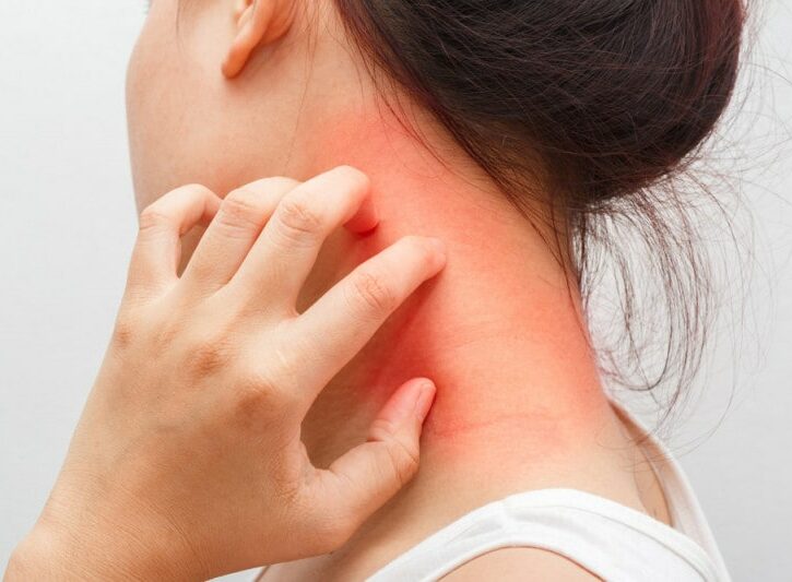 Dermatite atopica: cibi da evitare
