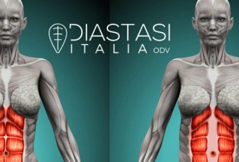 Diastasi addominale post parto: sintomi, diagnosi e cura