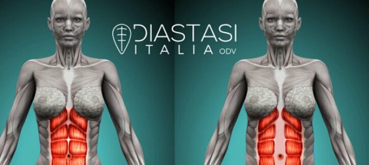 Diastasi addominale post parto: sintomi, diagnosi e cura
